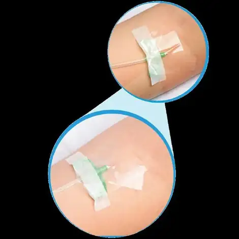 Fixapro Fístula
